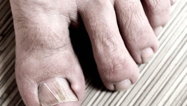Treating Ingrown Toenails in Humble TX