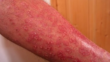 Psoriasis Doctor Near Me