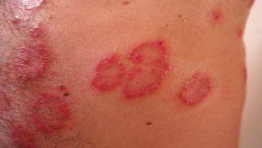 Understanding Shingles