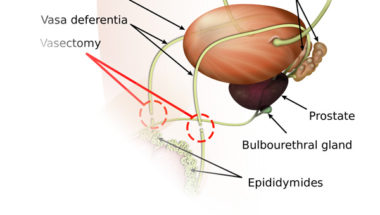 10 Facts About Getting A Vasectomy