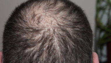Early Signs of Lupus