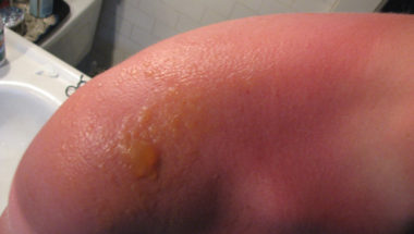 4 Signs Of A Sunburn