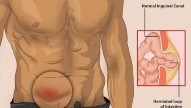 Hernia Treatment in Humble TX