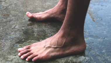 Varicose Vein Dermatologist Humble TX
