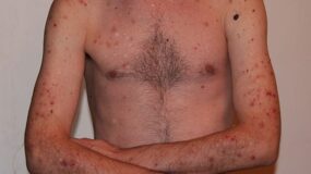 Dermatologist for Eczema Treatment in Humble TX