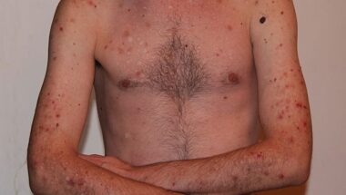 Dermatologist for Eczema Treatment in Humble TX