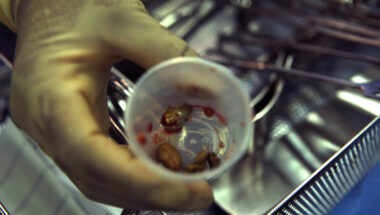 Kidney Stone Treatment in Humble TX