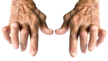 Rheumatoid Arthritis Doctor in Humble TX